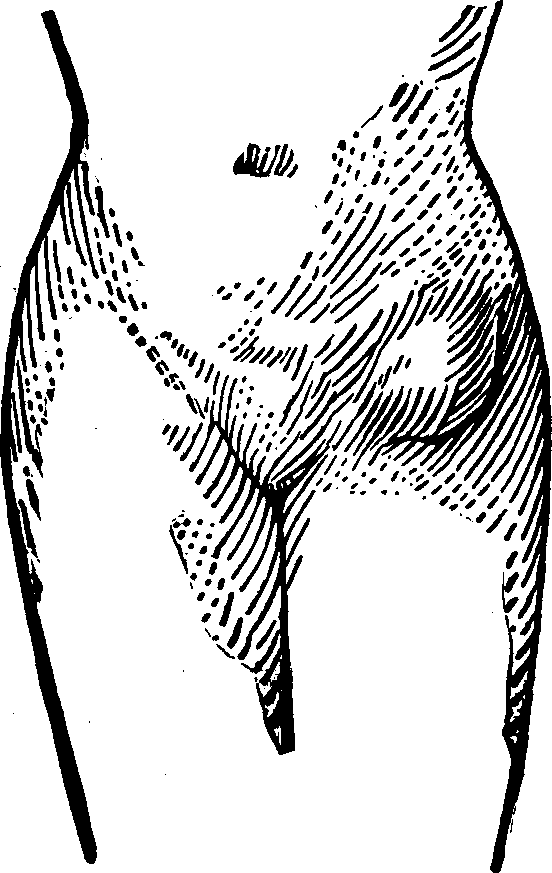 Illustration:
Fig. 2. This figure illustrates a case of Femoral Hernia