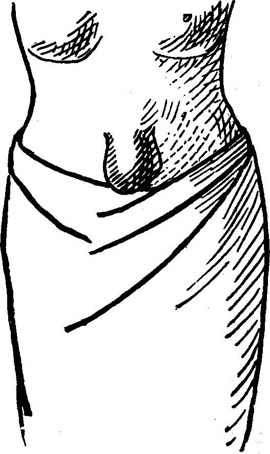 Illustration:
Fig. 3. UMBILICAL HERNIA.