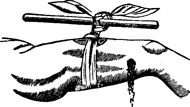 Illustration:
Fig. 1. The field Tourniquet as applied.