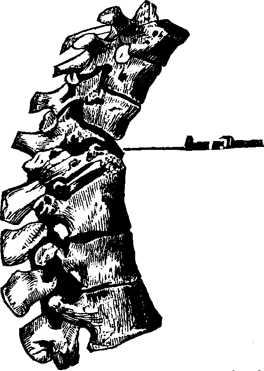 Illustration:
Fig. 1. The above portion of the spinal column shows the manner of the
breaking down of the vertebræ from caries, and the absorption of
their bony structure.