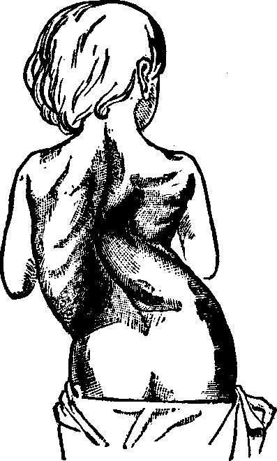 Illustration:
Fig. 9. Lateral curvature in an advanced stage.